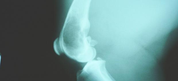 Radiografía de un osteosarcoma en el fémur.